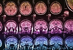 Cómo cambia el cerebro un trauma infantil