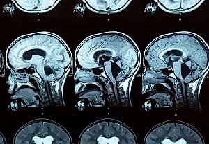 Infecciones cotidianas y ictus infantil: una relación oculta