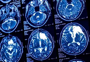 Cuando la bebida «ligera» adelgaza la corteza cerebral