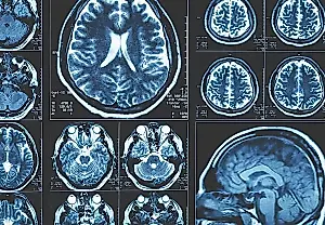 El coronavirus ataca el cerebro: repunte de trastornos autoinmunes