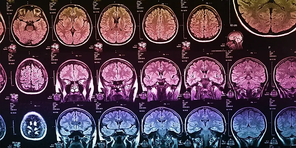 Cómo cambia el cerebro un trauma infantil