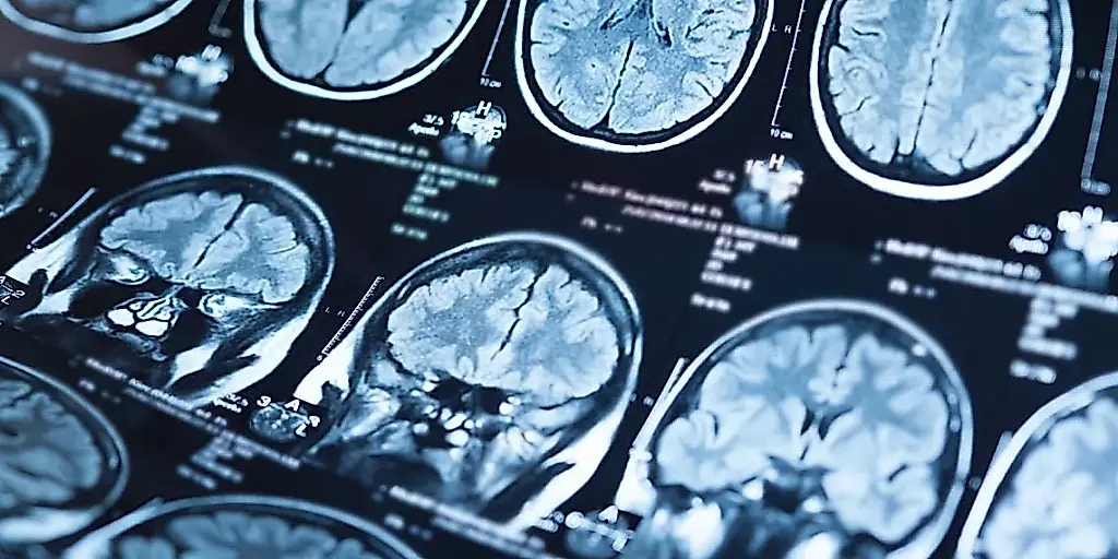 El dinero se come el cerebro