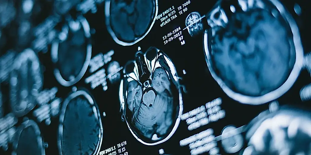 TDAH infantil: diferencias en el desarrollo de la sustancia blanca cerebral